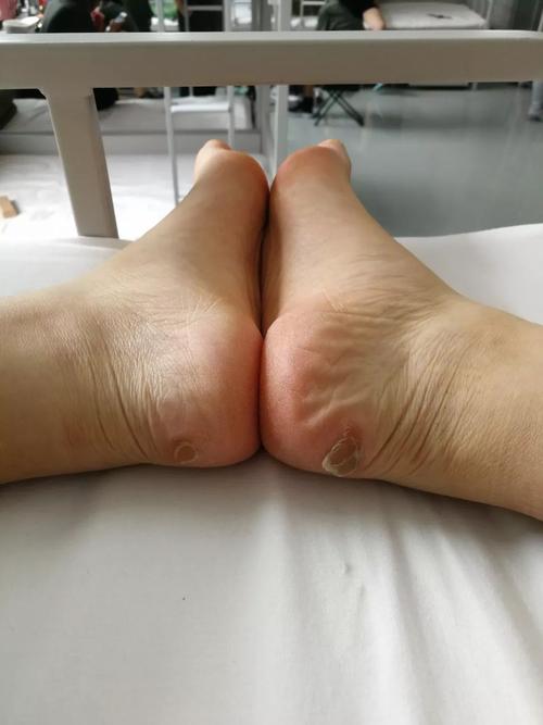 脚趾挤压变形,脚后跟被磨出厚厚的茧子