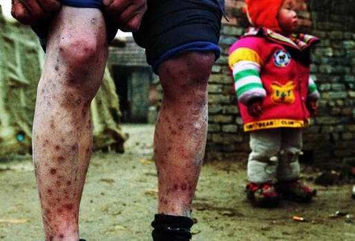 艾滋病皮疹是怎样的 得了艾滋病有什么特点