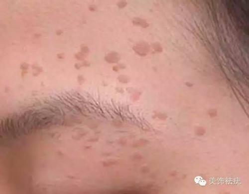 扁平疣的症状特征和种类