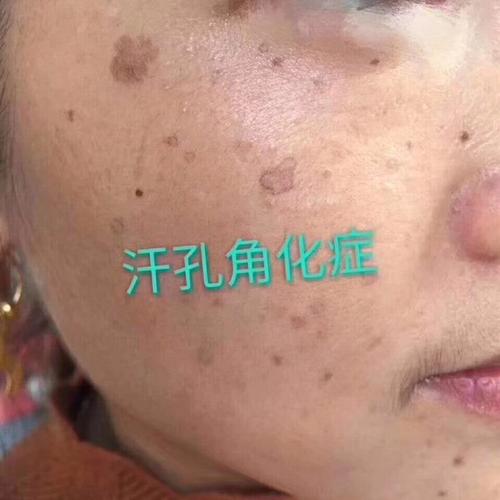 空心斑～汗孔角化症 是一种少见的遗传性角化性皮肤病