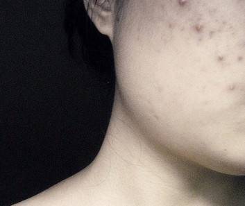 2,黑色/褐色痘印