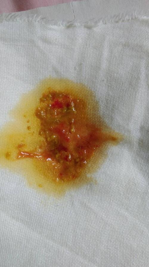 宝宝72天 突然拉的大便有血之前每天最多排两次大便 今天排了三次