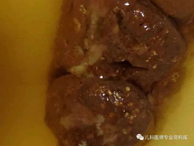 宝宝大便色彩,奶瓣,泡沫,黏液的超全解析(便便真图,敏感者慎入)