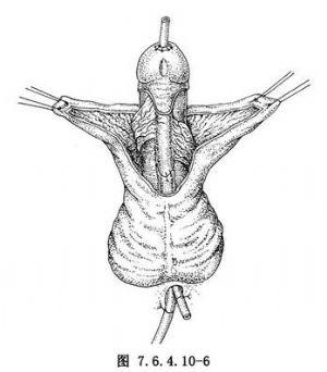 弧形带蒂阴茎阴囊联合皮瓣尿道成形术