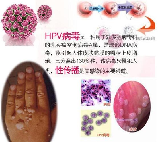 hpv病毒全面解读,一文看懂