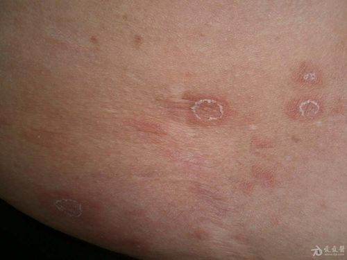 玫瑰糠疹.