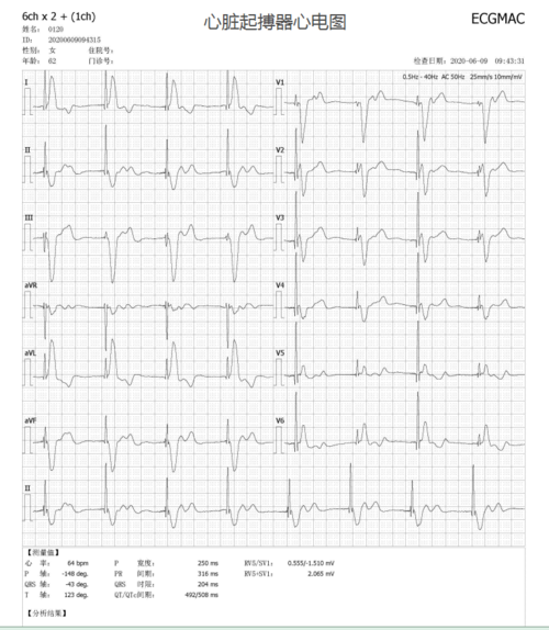 心脏起搏器心电图