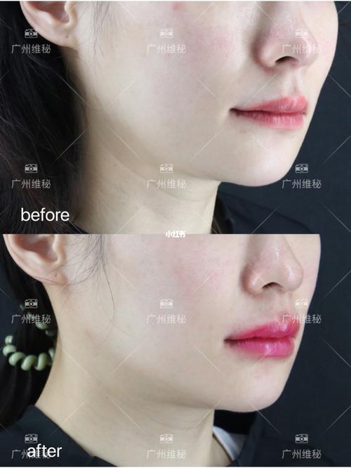 肉毒注射|下颌线提升77颈阔肌放松,案例分享_下颌线