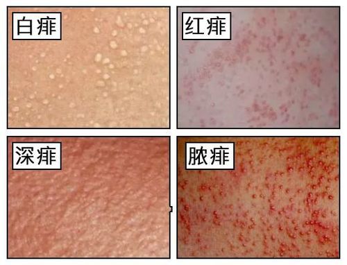 痱子 图片来源:uptodate.com