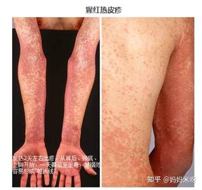 儿科医生推荐婴幼儿猩红热常见症状及其防护