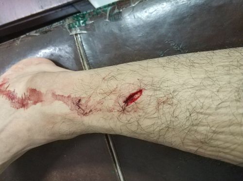 小腿刀伤缝合脚背没多大知觉