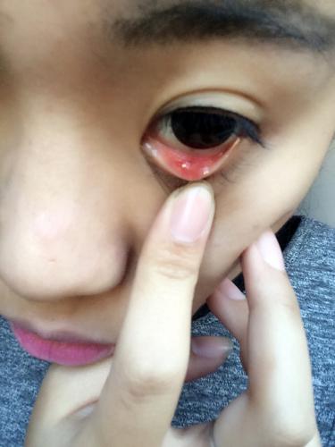眨眼疼痛.今天肿起来了.翻开眼皮有一个白色的