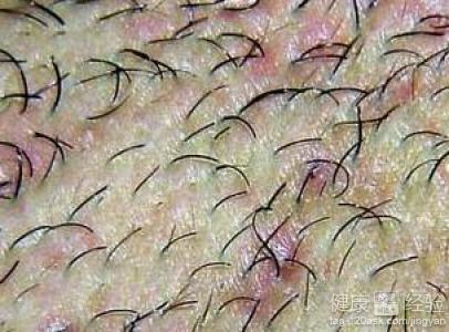 毛囊炎的危害表现在哪里