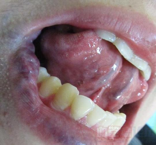 舌部血管瘤的危害有哪些