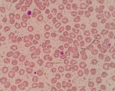 虚惊一场的血小板危急值