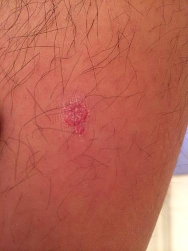 皮肤性病科 皮肤科 → 我身上这是长的什么,不痒,脱皮,好久了