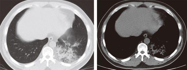 右中叶实变右上肺可见大片状实变影,以叶间裂为分界图1 右上叶大叶性