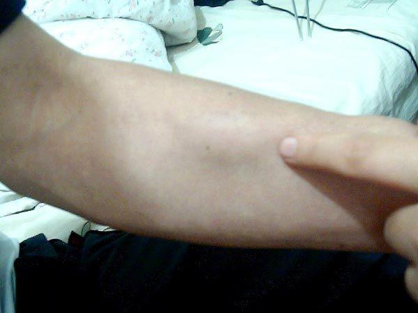 脂肪瘤是由哪些因素导致的