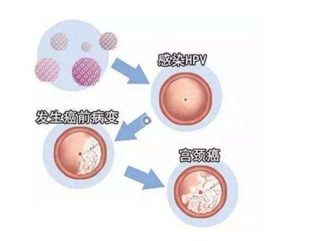 怀孕后发现hpv感染,怎么办?