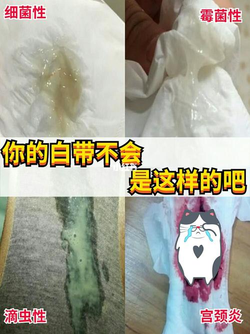 讨厌的霉菌性阴道炎,你的内裤是否这种情况_妇科炎症