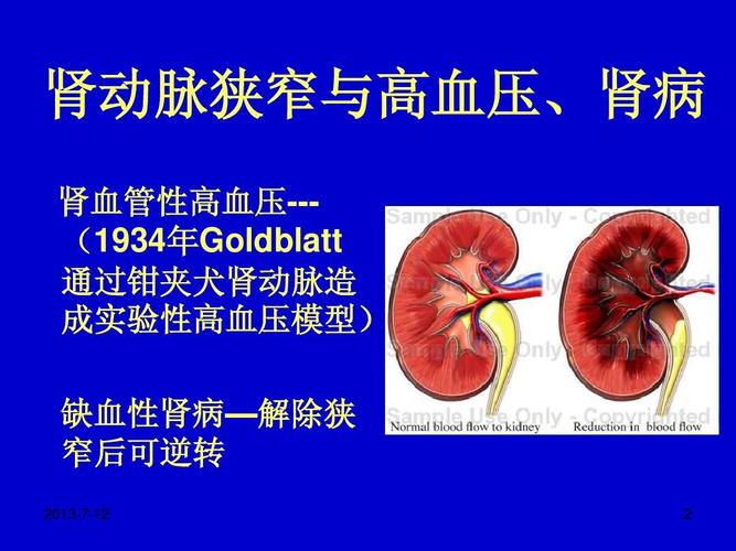 肾血管性高血压的诊断与治疗.ppt