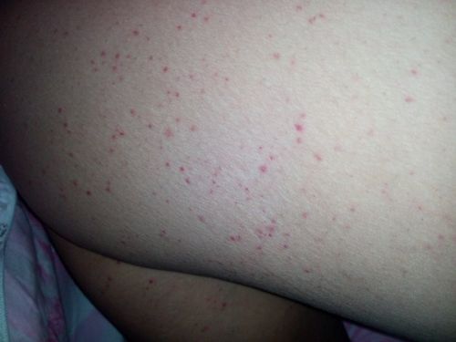 不详,我前两天感冒发烧这几天挂点滴呢,今天才发现腿上出了这些红点