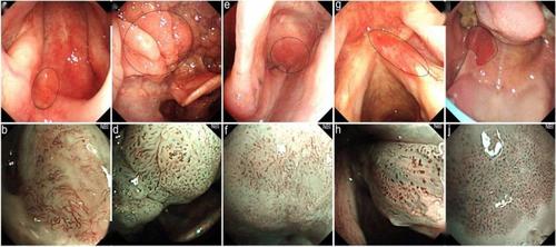 健康科普园地丨咽喉疾病为何要做喉镜检查