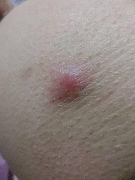 臀部长这么大个包 是怎么回事 不碰它不疼