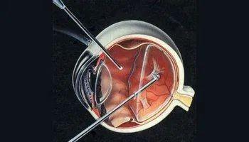 但随着年龄增长,玻璃体会液化或后脱离,产生一些混浊物,这些混浊物