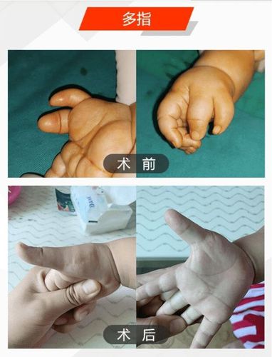 多指不能一剪没要更加个性化精细化地来解决宝宝多指问题