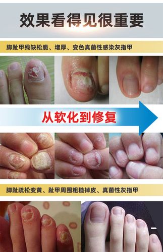 灰指甲专用药正品脱甲膏治疗指甲软甲非冰醋酸甲沟炎抑菌液植甲素