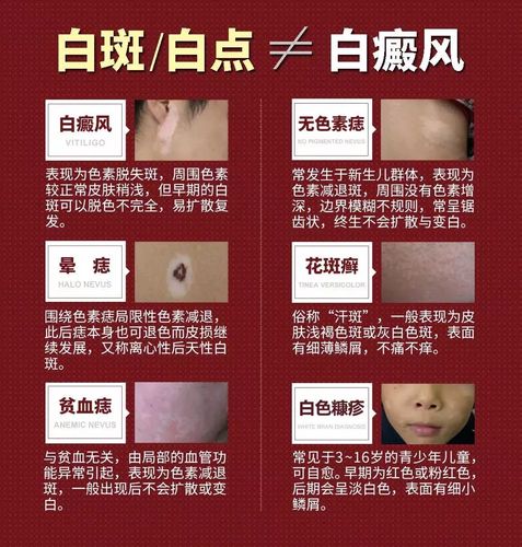 白斑?白点?白癜风?兰州白癜风医院教您三步确诊!