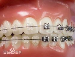 陶瓷托槽和普通托槽对比照