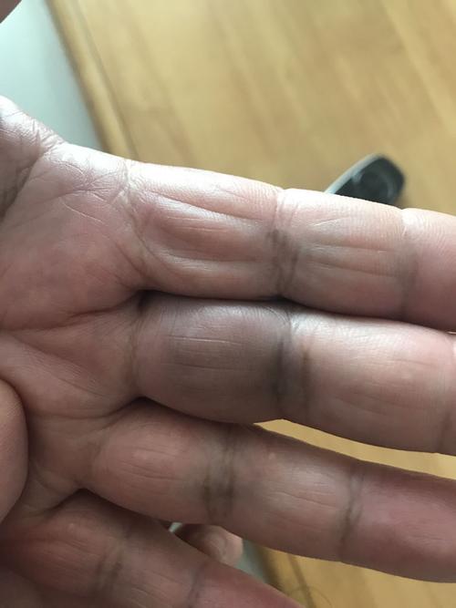 老人左手中指无名指靠近手掌的那一节手指肿胀发青.一碰到就疼