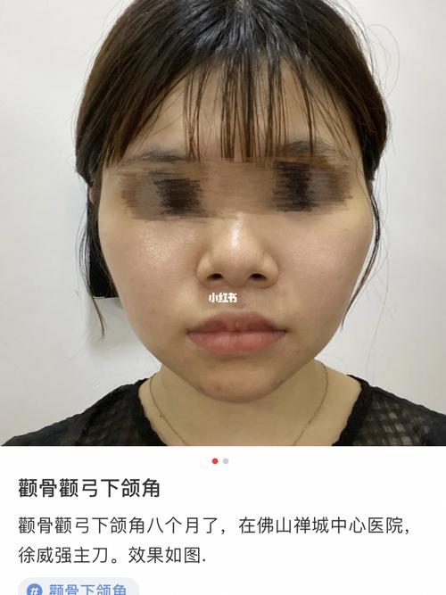 颧骨颧弓下颌角_颧骨_下颌角_佛山禅城中心医院_颧骨下颌角_美妆_医美