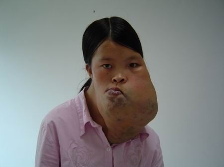 女孩长巨瘤面部变形 两妹妹辍学打工救姐姐(图)