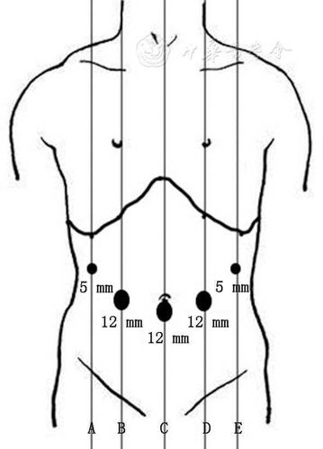 手术戳卡孔的布局