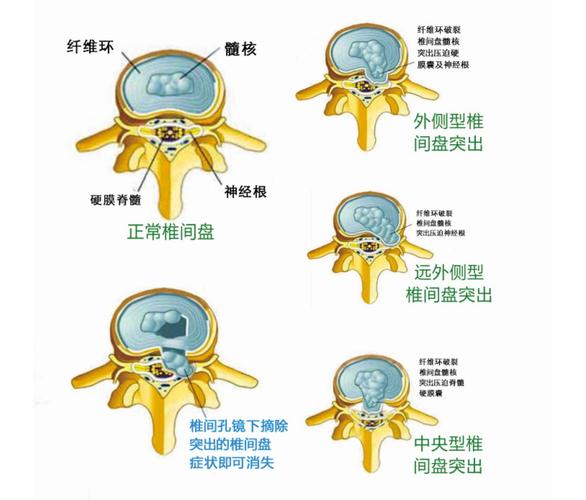 腰肌劳损,腰椎滑脱,腰椎管狭窄,椎间盘突出,这些腰部疾病该怎么治?