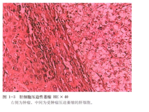 [医学]病理图谱.ppt