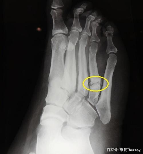 走这么多路,不怕骨折吗?医生提醒,走路脚疼要小心是骨折