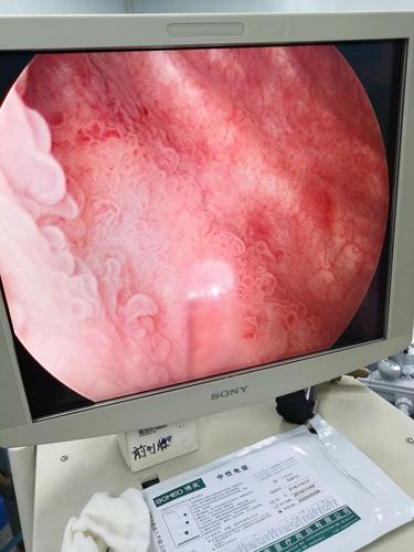 膀胱肿瘤电切术后3年复发,膀胱右侧壁可见多发水草,绒毛状肿物.