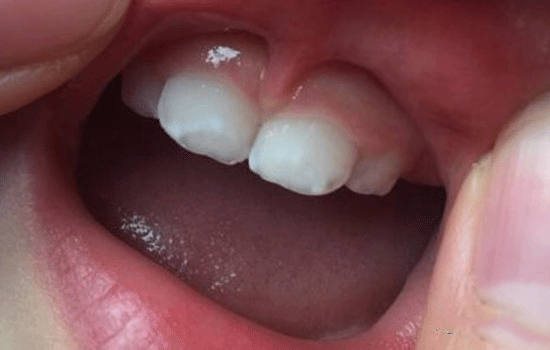 宝宝牙齿有白斑