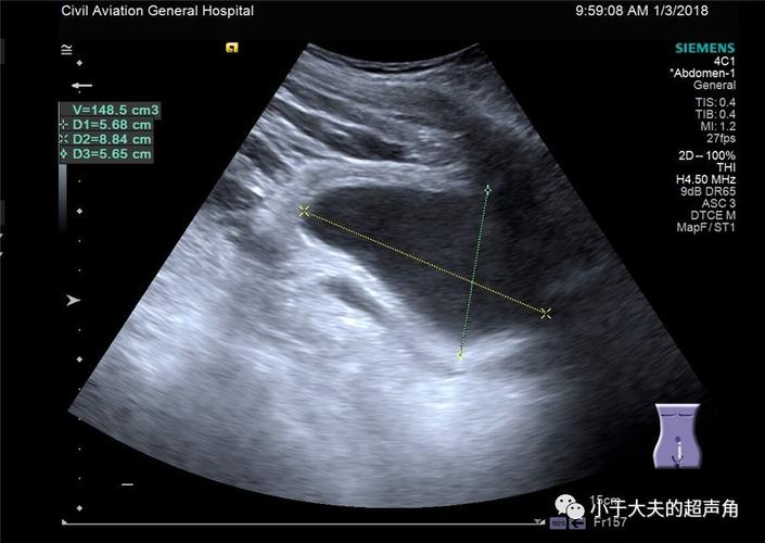 图6-7:膀胱充盈欠佳,排尿后残余尿量149ml.
