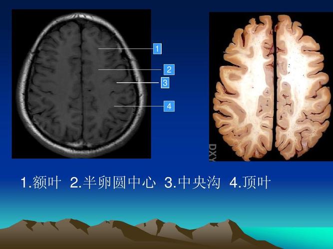 额叶 2.半卵圆中心 3.中央沟 4.顶叶