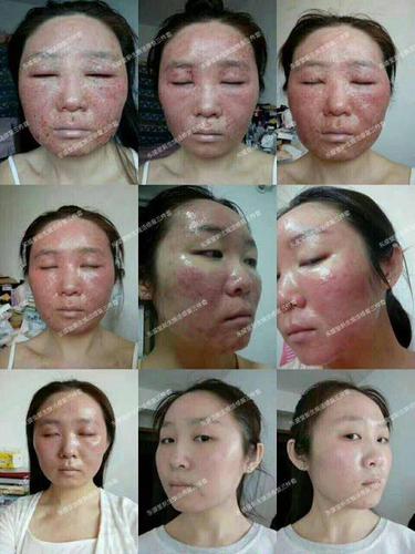 7,角质层越来越薄,细干纹提早出现,暗含红血丝.