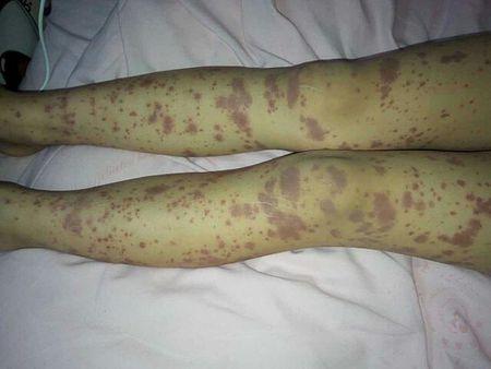 我侄女最近吃牛肉皮肤过敏了,花了几