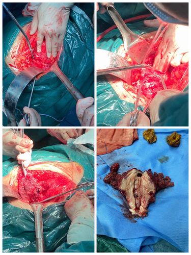 困难的卵巢癌手术一例