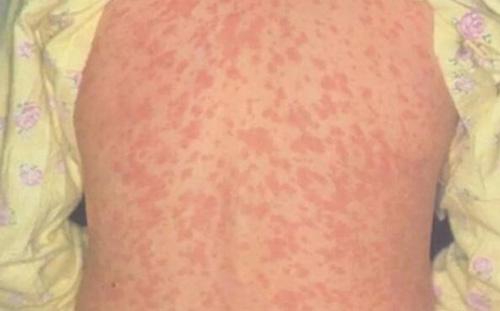 猩红热是怎样惹起的?宝宝猩红热有哪些症状