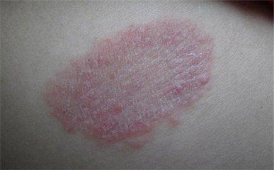 体癣会引发哪些并发症