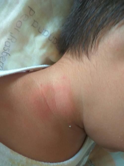 一早起来儿子脖子上一片红色,他说痛,有谁知道这是被什么虫子爬了还是